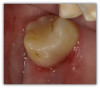 Fig 8b. A terminal abutment with proximal decay from a
removable cast metal partial denture. The composite used was
Tokuyama Omnichroma flow bulk.