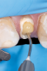 Fig 15. Flowable resin composite injected into the post channel using an angled tip.