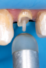 Fig 19. After silane application to the remaining coronal portion of the post and existing composite material, a universal adhesive was applied to the tooth structure and fiber post and allowed to dwell for 10 seconds, air-dried, and light-cured.