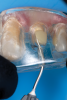 Fig 20. The clear silicone matrix was placed over the posterior segment of the maxillary arch, and flowable resin composite was injected through a small opening above the preparation and fiber post.