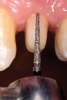 Fig 22. The preparation was completed using a tapered diamond bur.