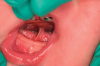 (2.) Retraction of the tongue is achieved with a grooved director with polished edges, which facilitates visual identification of the frenulum, lingual veins, saliva ducts, and salivary tubules.