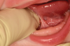 (3.) Preoperative and postoperative retracted views of a case involving an excessive tongue-tie that was treated with laser surgery.