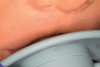 (6.) Preoperative retracted and pacifier views of a baby with lip-tie. Note how the upper lip is tucked under on the pacifier, causing a break in the latch seal.