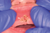 (7.) Postoperative retracted view following laser frenectomy.