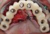 (23.) Full-arch treatment using a stackable surgical guide that employs components that attach to a foundation base, including views with the pin guide attached to the foundation base inserted over the existing dentition, the osteotomy guide attached and osteotomy being performed, the implants placed and the multi-unit abutments attached, and a prefabricated temporary prosthesis attached to the foundation base, ready to be luted to temporary cylinders for intraoral pickup, respectively.