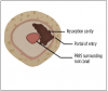 (4.) Vertical and horizontal cutaway views of an ECR lesion’s progression into a tooth’s structure. Note how its spread into the pulp is prevented by the PRRS.