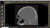 Fig 5. Case 2. Preoperative CT imaging from otolaryngologist showing periapical radiolucency associated with tooth No. 14 and associated maxillary sinus mucositis.