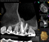 Fig 10. CBCT imaging at 3-month follow-up showing signs of healing and decrease in maxillary sinus mucositis. Fig 10: Sagittal view, buccal roots No. 14. Fig 11: Sagittal view, palatal root No. 14.