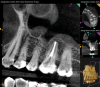 Fig 11. CBCT imaging at 3-month follow-up showing signs of healing and decrease in maxillary sinus mucositis. Fig 10: Sagittal view, buccal roots No. 14. Fig 11: Sagittal view, palatal root No. 14.