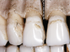 Fig 1. A skull’s maxilla. The interdental osseous crest between teeth Nos. 8 and 9 is 3 mm coronal to the facial bone height.