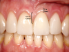 Fig 2. The buccal and lingual gingival level is located 2 mm to 3 mm coronal to the osseous crest. The interdental papilla between the central incisors is 4.5 mm to 5 mm coronal to the osseous crest. This is due to papillary hypertrophy.