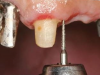 Fig 6. Tooth No. 8 mesial. An 859 diamond bur is sunk 10 mm on the proximal surface to facilitate easy extraction of maxillary anterior teeth. The diamond should be tilted to follow the tooth contour.