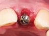 Fig 12. A healing abutment is placed and the buccal gap filled with bone graft material.