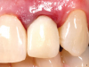 Fig 14. The provisional crown is inserted on the day of surgery. Note the height of the gingiva.