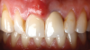 Fig 2. Case presentation of SPOT technique used on central incisor. Initial presentation, facial view, of maxillary right central incisor with hopeless prognosis due to subgingival caries and horizontal fracture.