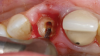 Fig 7. SPOT Step 3: Two pilot hole trajectories are drilled using a carbide bur (Meisinger HM162SX-014). The first pilot hole trajectory reaches the root apex, removing all root canal contents, including any filling materials. The second pilot hole trajectory establishes the implant osteotomy. (Figure 8 is a composite illustration provided by the authors.)