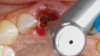 Fig 9. SPOT Step 4: Densah burs VT1525 (2.0) and VT1828 (2.3) are used at 1,200 rpm with irrigation in CW mode to widen the root canal hole trajectory to provide further and complete apex removal. The same burs are then used to establish the implant osteotomy. In some cases, the two trajectory holes might eventually overlap. (Figure 11 is a composite illustration provided by the authors.)