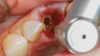 Fig 10. SPOT Step 4: Densah burs VT1525 (2.0) and VT1828 (2.3) are used at 1,200 rpm with irrigation in CW mode to widen the root canal hole trajectory to provide further and complete apex removal. The same burs are then used to establish the implant osteotomy. In some cases, the two trajectory holes might eventually overlap. (Figure 11 is a composite illustration provided by the authors.)