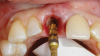 Fig 12. SPOT Step 4, cont’d: Densah Bur VT2535 (3.0) is used at 1,200 rpm with adequate irrigation in CCW mode to achieve final implant osteotomy preparation. This facilitates autografting of bone and dentin particles into the palatal alveolar trabecular bone space.