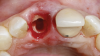 Fig 13. SPOT Step 5: The mesial-distal root split is prepared with a long shanked carbide bur (Meisinger HM34IL-012) without violating the implant osteotomy.