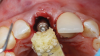 Fig 15. SPOT Step 6: The implant is placed to the preplanned depth in the implant osteotomy, and the jumping gap is grafted.