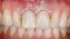 Fig 18. At 3 weeks postoperative, note healing and adequate soft- and hard-tissue volume.