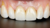 Fig 21. One-year postoperative, final crown restorations. Note soft- and hard-tissue volume maintenance in the right central incisor (socket-shield site).