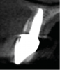 Fig 22. One-year postoperative CBCT with final restoration demonstrating adequate restorative space between the restoration and the socket shield as well as adequate bone fill between the implant and the socket shield.