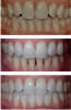 Top panel: Before aligner therapy. Middle panel: Postorthodontic movement caused black triangles to develop. Crowding can “strangulate” the gingival papilla, and often spaces are created between the gingival and interproximal contacts of the teeth when aligned. Bottom panel: Postrestorative closure of spaces.