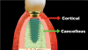 (4.) Specialized drills permit osteotomy preparation and implant placement into vital cancellous bone, which is more vascular than cortical bone and can help to reduce bone loss.