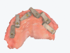 (13.) Intraoral retracted view and scanning software view, respectively, of elongated scan bodies designed to reduce the space between dental implants. The unique shapes of these scan bodies prevent the scanner software from confusing them with one another.