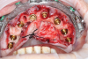 (22.) Full arch treatment using a stackable surgical guide that employs components that attach to a foundation base, including views with the pin guide attached to the foundation base inserted over the existing dentition, the osteotomy guide attached and osteotomy being performed, the implants placed and the multi-unit abutments attached, and a prefabricated temporary prosthesis attached to the foundation base, ready to be luted to temporary cylinders for intraoral pickup, respectively.