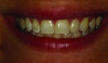 (2.) Posttreatment smile photograph after delivery of a no preparation leucite-reinforced ceramic veneer with a light-cure only resin cement.