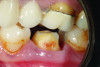 (4.) Pretreatment close-up retracted view of tooth No. 19 demonstrating a crown preparation with conventional retention and resistance form.