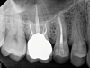 (2.) NSRCT, which had previously been completed on tooth No. 3, was also completed on tooth No. 4 prior to initiating surgical repair of the ECR lesions because it exhibited signs and symptoms of irreversible pulpitis.