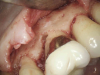 (3.) The initial surgical exposure revealed defects coronal to the crestal bone that were filled with granulation tissue and consistent with ECR.