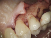 (4.) The granulation tissue was removed in its entirety, and the defects were treated with a 90% TCA solution.