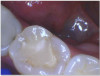 Fig 3a. A direct composite using Kerr SimpliShade Bulk Fill Packable.