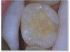 Fig 4b. Carious lesion on tooth No. 19 requiring
a deep excavation in which an indirect pulp cap was performed using a light curable resin-modified calcium silicate (Bisco TheraCal LC), and
the tooth was subsequently restored in two separate steps using Kerr SimpliShade Bulk Fill Flow followed by SimpliShade Bulk Fill Packable
as the capping layer.