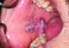 Fig 1. SLE-related oral lesions are seen on the buccal mucosa
(Fig 1, right buccal mucosa; Fig 2, left buccal mucosa) of a 25-yearold
male patient, who had a history of and was previously diagnosed
with SLE. The findings were reported by the oral pathologist who
provided the photographs (photographs courtesy of Iona Leong, BDS,
University of Toronto).