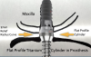 (18.) Abutment design allowing 2 mm intaglio relief.