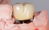 (22.)  Molar custom abutment.