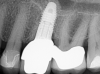 (25.)  Molar custom abutment.