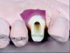 (27.) Premolar custom abutment.