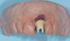 (35.) Single anterior custom abutment workflow.