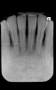 Fig 5. Initial radiograph of the Case 1 patient, teeth Nos. 22 through 27.