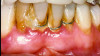 Fig 7. Case 2. Initial presentation of a patient with periodontitis (teeth Nos. 22 through 27). Generalized pocket depths of 6 mm to 7 mm were present, with wire splint on teeth Nos. 23 through 25.