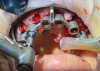 (21.) Full arch treatment using a stackable surgical guide that employs components that attach to a foundation base, including views with the pin guide attached to the foundation base inserted over the existing dentition, the osteotomy guide attached and osteotomy being performed, the implants placed and the multi-unit abutments attached, and a prefabricated temporary prosthesis attached to the foundation base, ready to be luted to temporary cylinders for intraoral pickup, respectively.