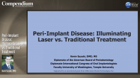 Peri-Implant Disease: Illuminating Laser vs. Traditional Treatment Webinar Thumbnail